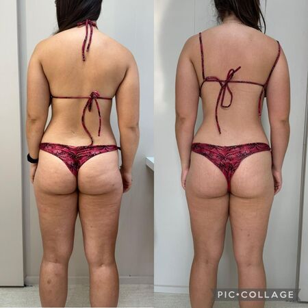 Resultado drenagem vibratória costas - Dra. Anna Abreu